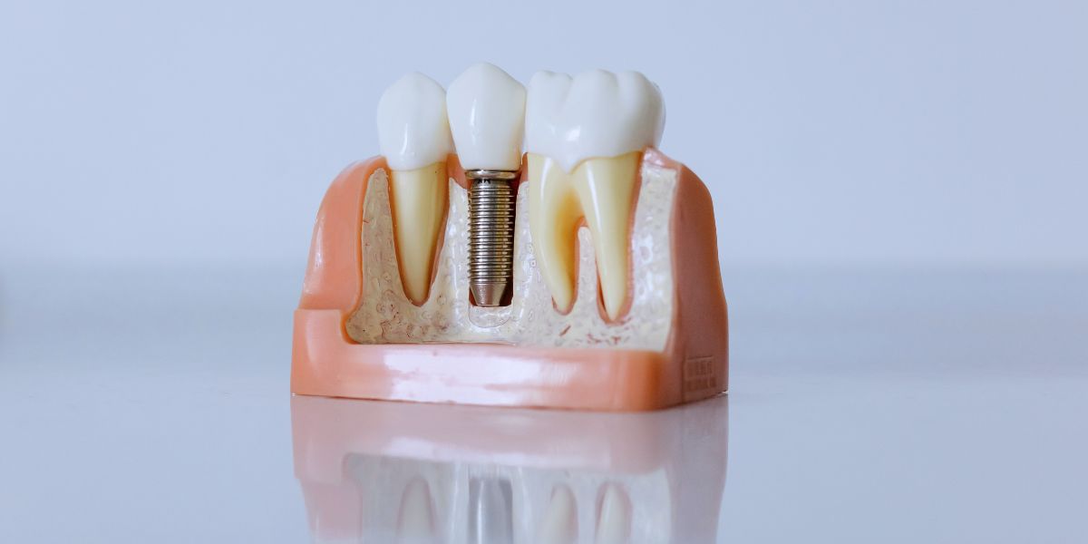 Muestra de Implantes dentales