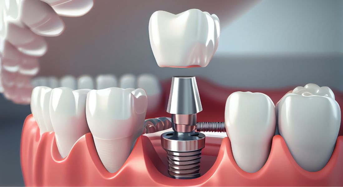 Implantes dentales para dentaduras completas