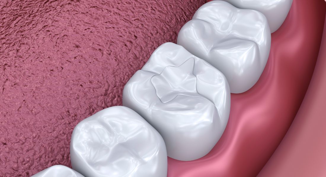 Qué hacer si se cae un empaste dental - Clínica Dental Frías - Clína Dental Barakaldo