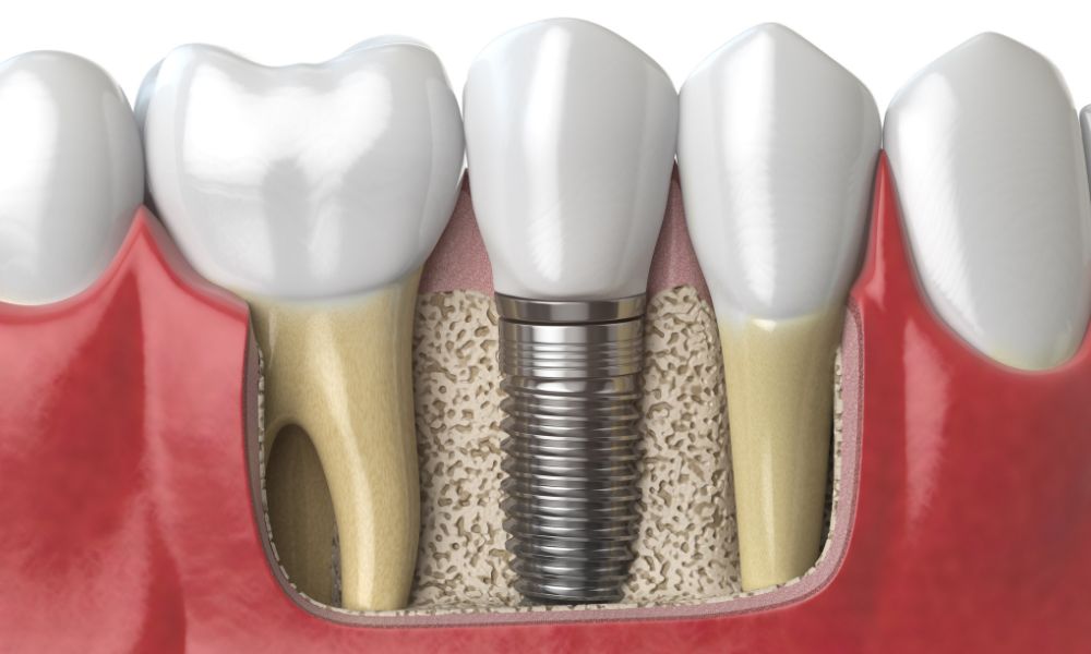 Infografía de un implante dental bien osteointegrado