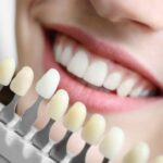 Blanqueamiento dental profesional evitando las Modas dentales peligrosas - Clínica Frías - Ortodoncia en Barakaldo