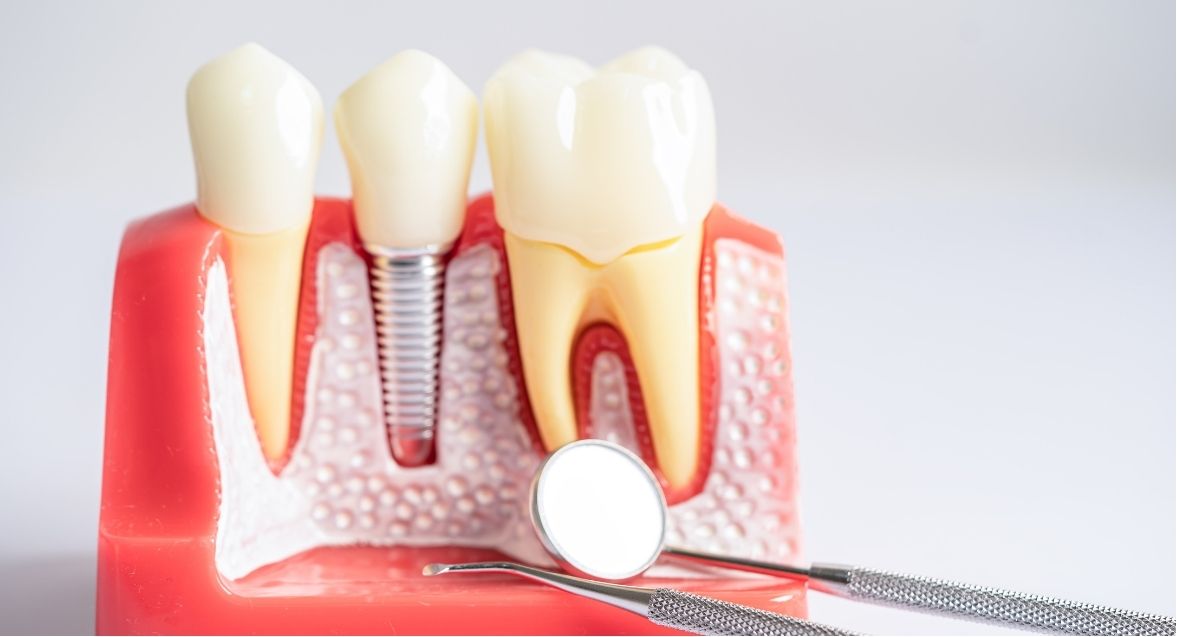 periimplantitis clínica dental Frias