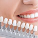 Consejos a seguir tras un blanqueamiento dental