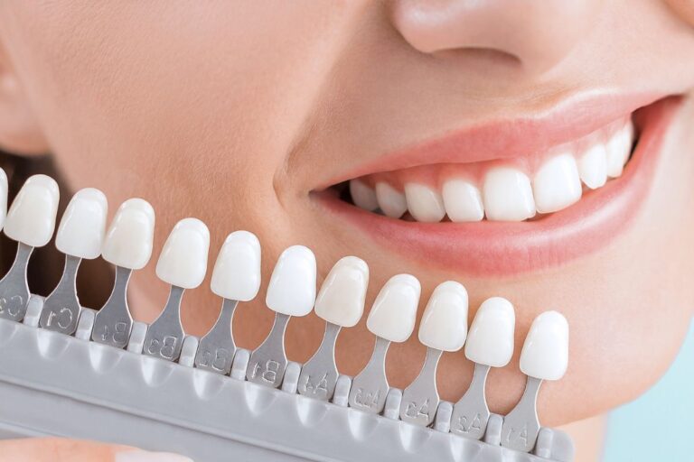 Consejos a seguir tras un blanqueamiento dental