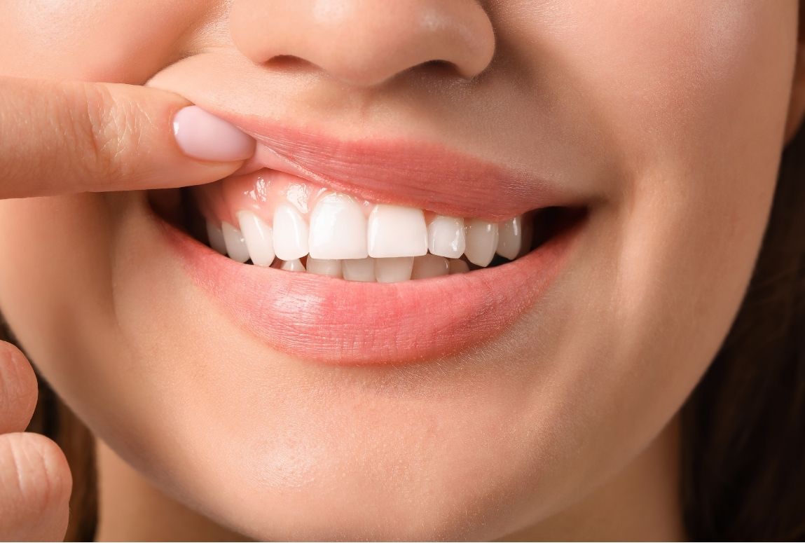 gingivectomía