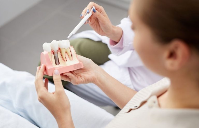 Implantes dentales