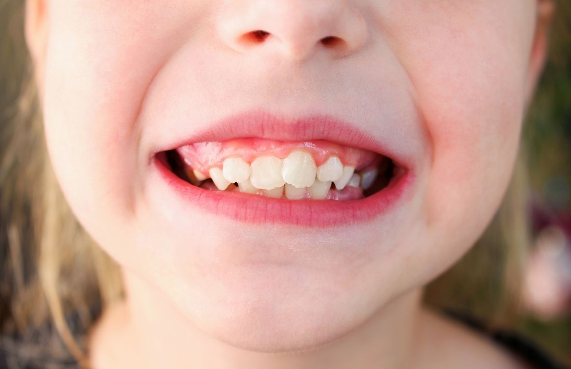 Apiñamiento dental