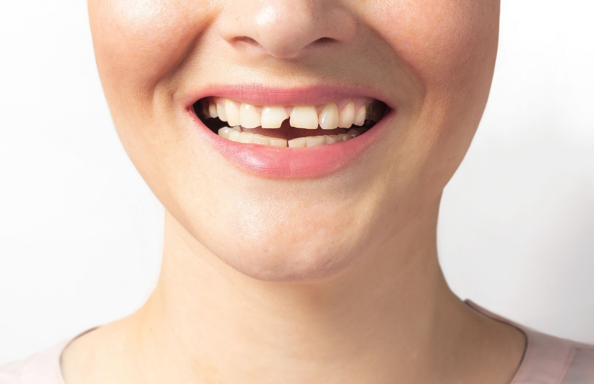 Microfracturas dentales, qué son. Clínica dental en Barakaldo, Frías